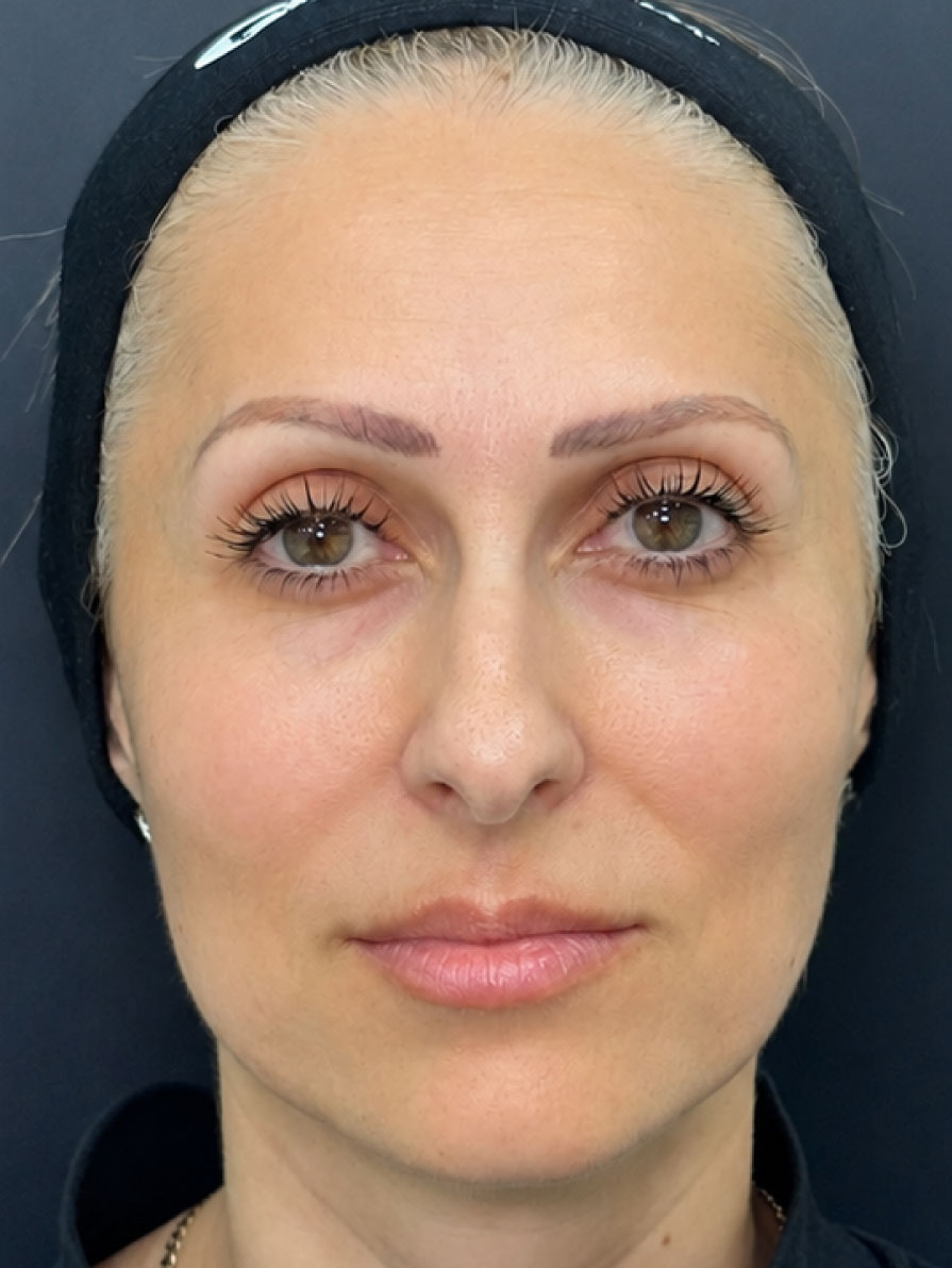 Fileri full face - poslije