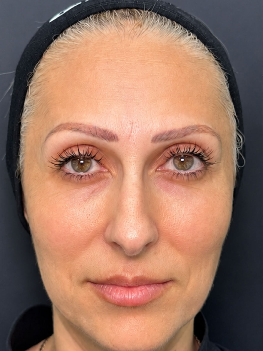Fileri full face - prije