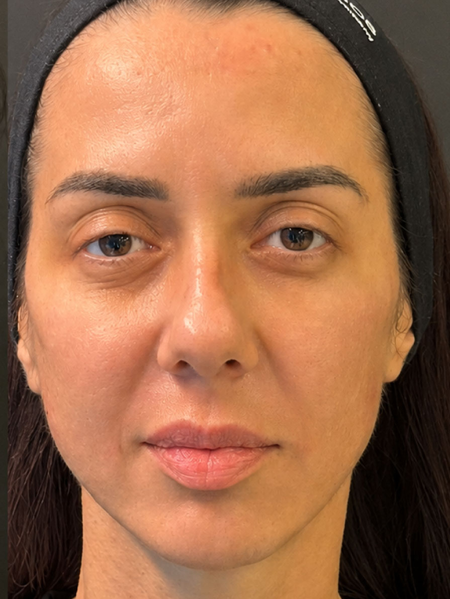 Fileri full face - poslije